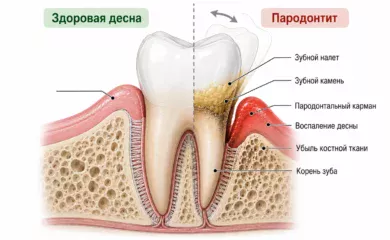 Имплантация при пародонтите