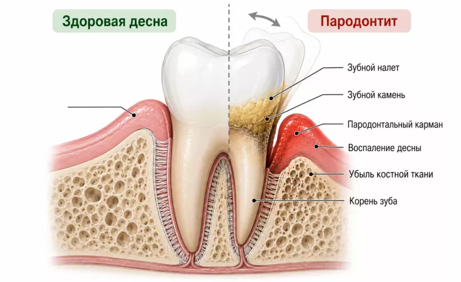 Имплантация при пародонтите