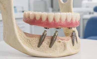 Базальная имплантация